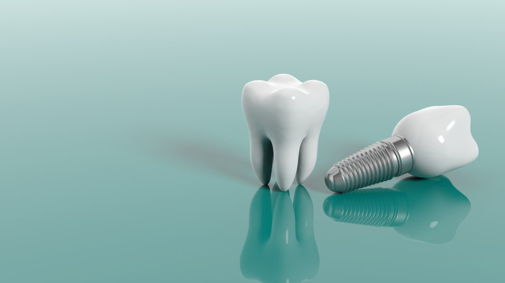 What Are the Different Types of Dental Implants That Exist Today?