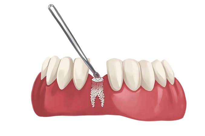 How Many Types of Dental Implant Procedures Are There?