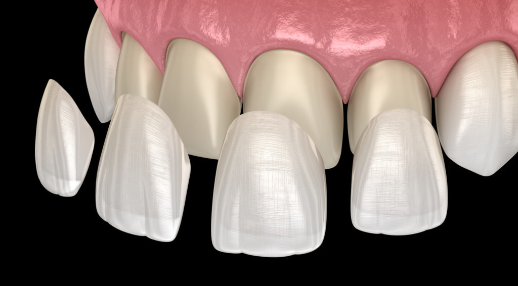 Beautiful Smiles: The Different Types of Veneers Explained