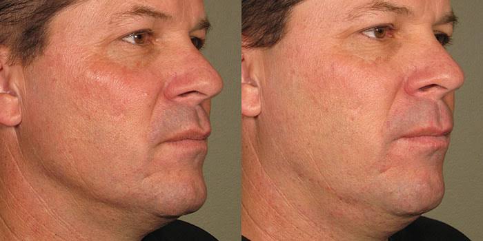 Thermage vs Ultherapy: What Are the Differences?