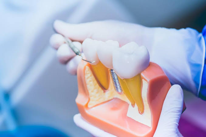 Cosmetic Dental Implants: Frequently Asked Questions
