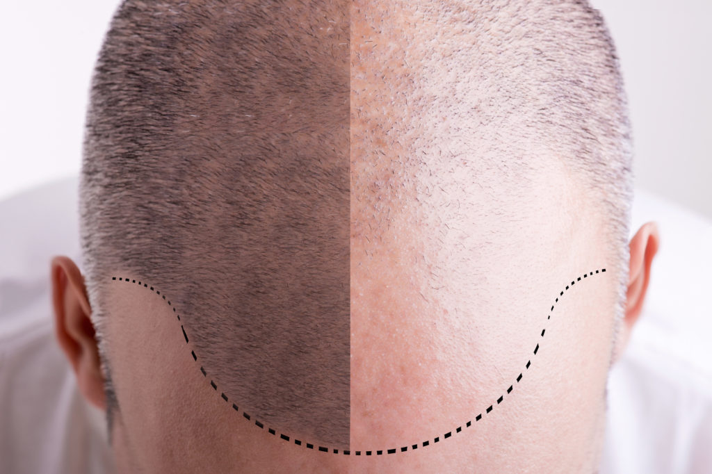 What Are the Benefits of Getting a Scalp Tattoo?