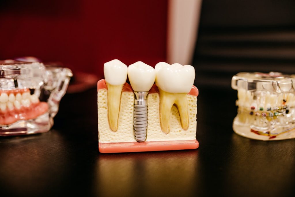 Dental Implants: Which One Is Right For You?