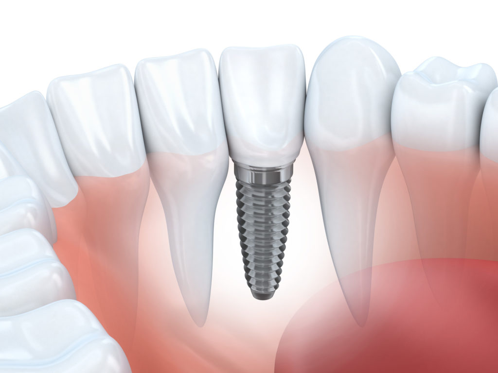 Dental Implants vs Root Canal: What Are the Differences?