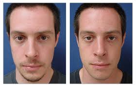 Closed vs Open Rhinoplasty: What’s the Difference?