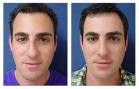 The Healing Stages of Rhinoplasty Surgery