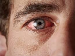 Why Are My Eyes So Dry?