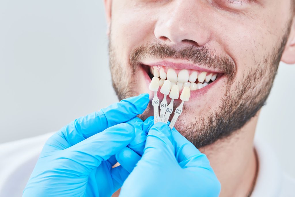 Braces vs Veneers: What Are the Differences?