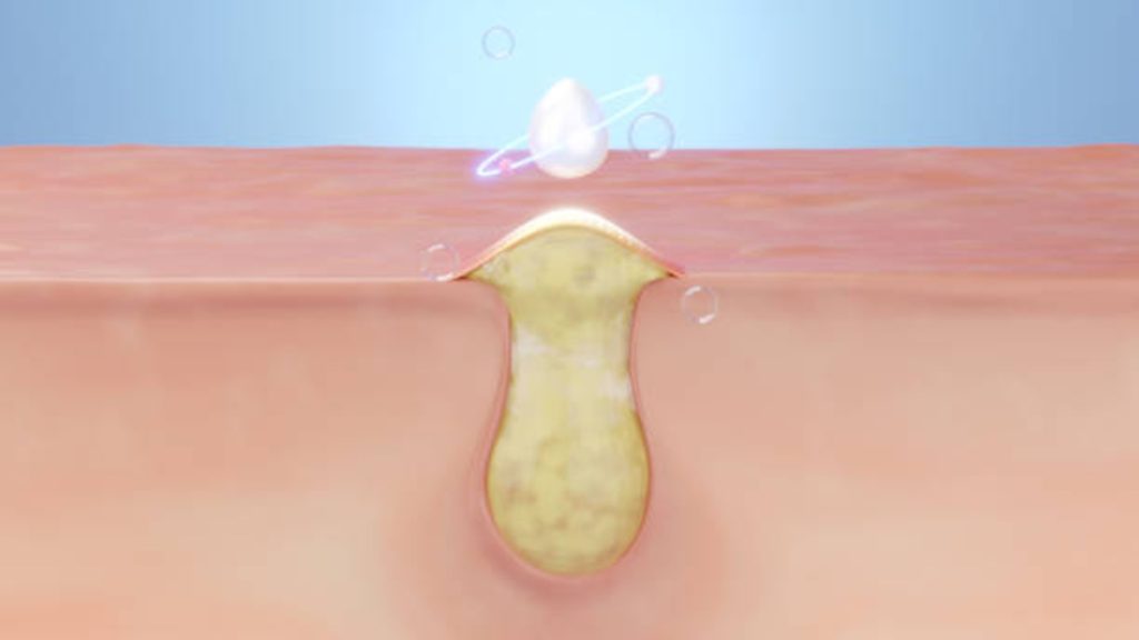 Follicle Rupture and Ovulation