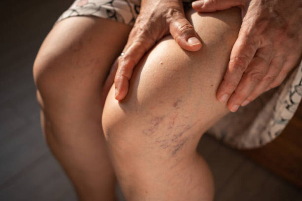 Leg Heaviness May Deserve More Than Everyday Wellness Advice Leg Heaviness May Deserve More Than Everyday Wellness Advice
