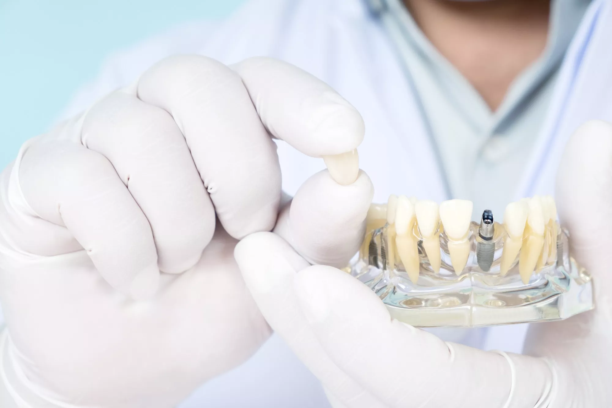 Hybrid Denture vs Overdenture: What’s the Difference?