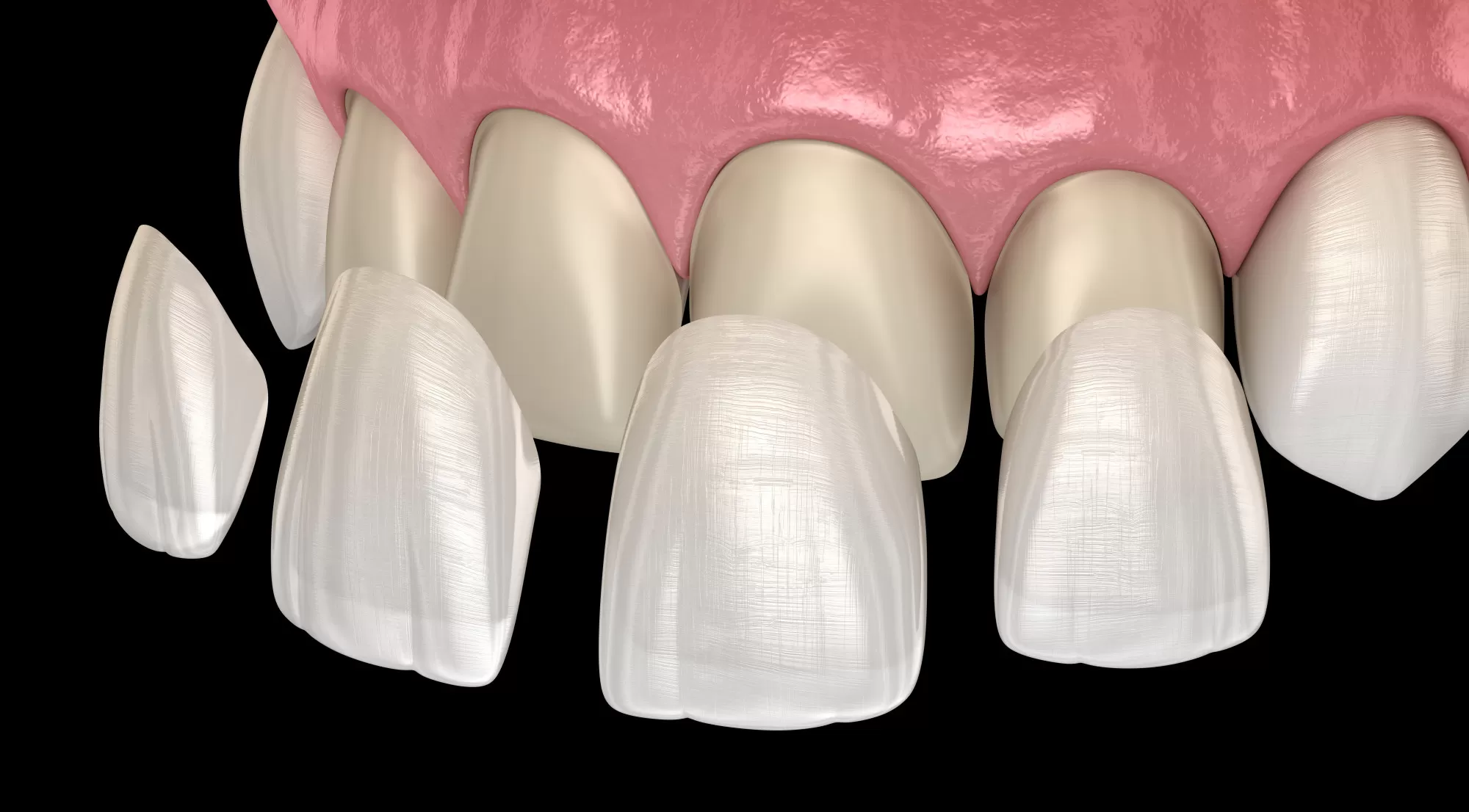 Beautiful Smiles: The Different Types of Veneers Explained
