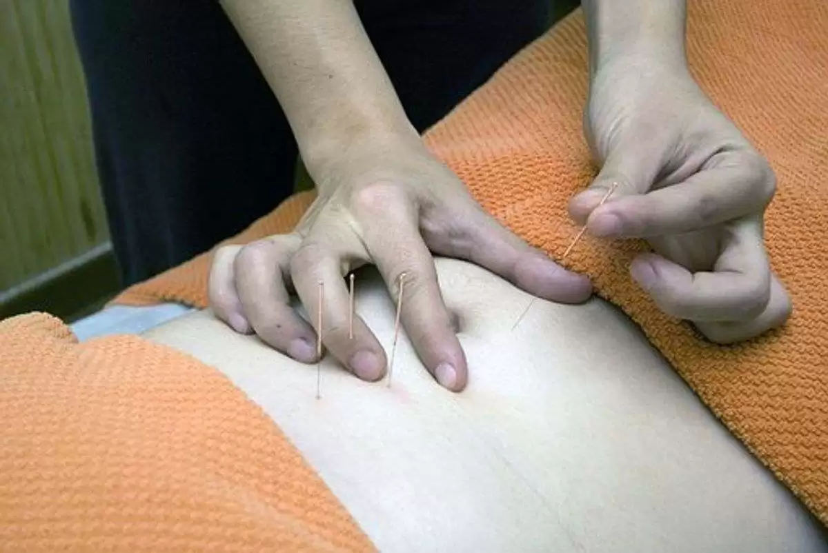 acupuncture NYC