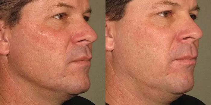 Thermage vs Ultherapy: What Are the Differences?