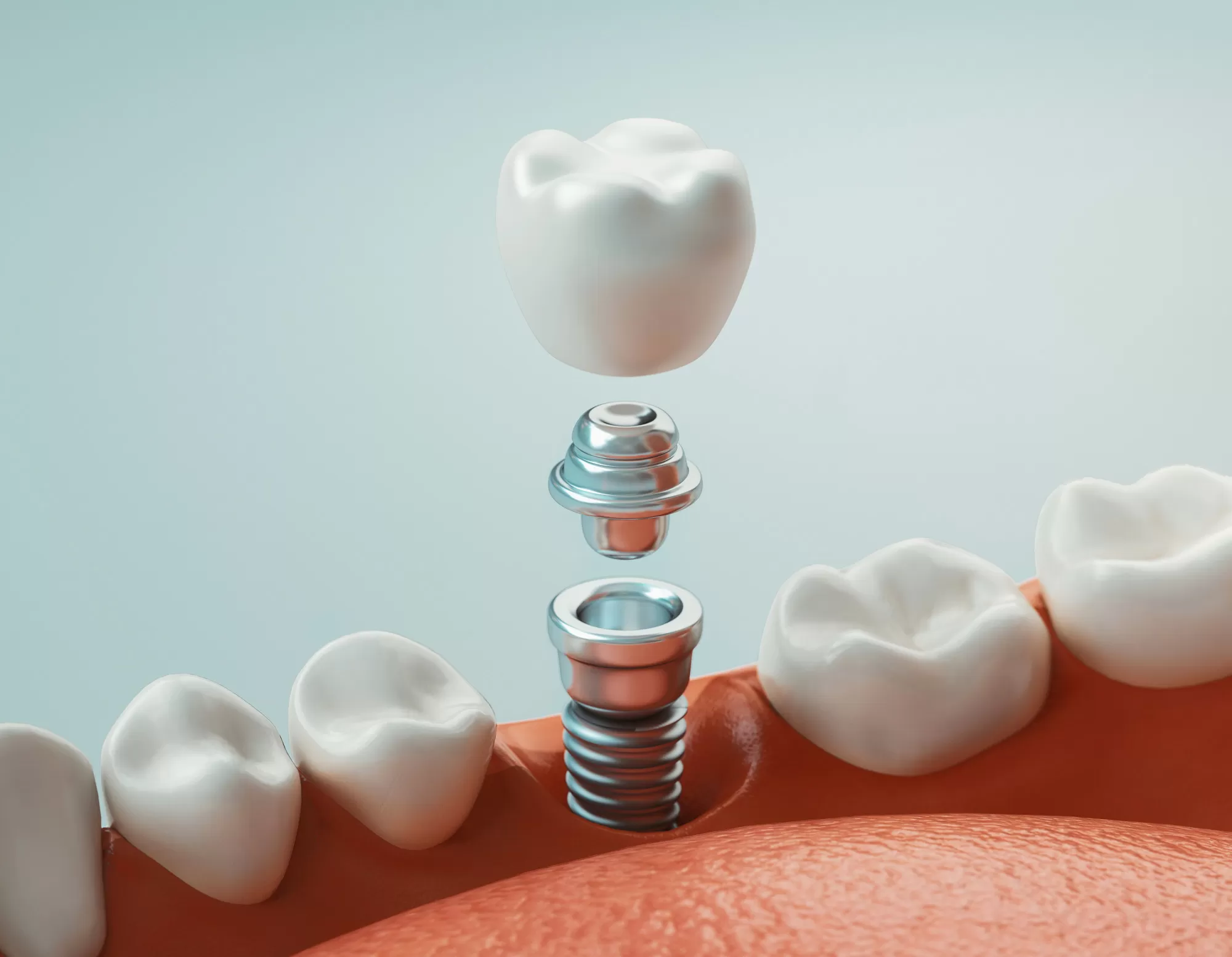 What Are the Different Types of Dental Implants That Exist Today?