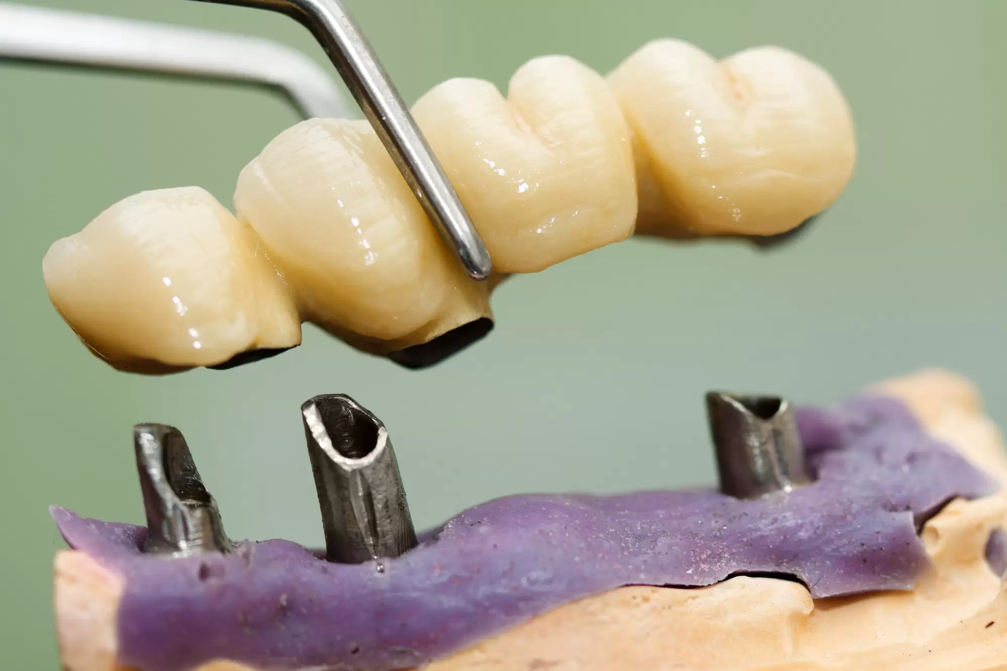 How to Clean Dental Implants