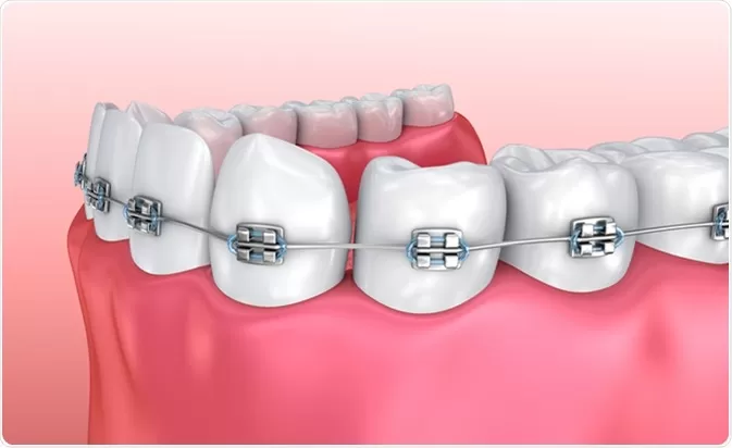 What Are the Different Types of Dental Braces That Exist Today?