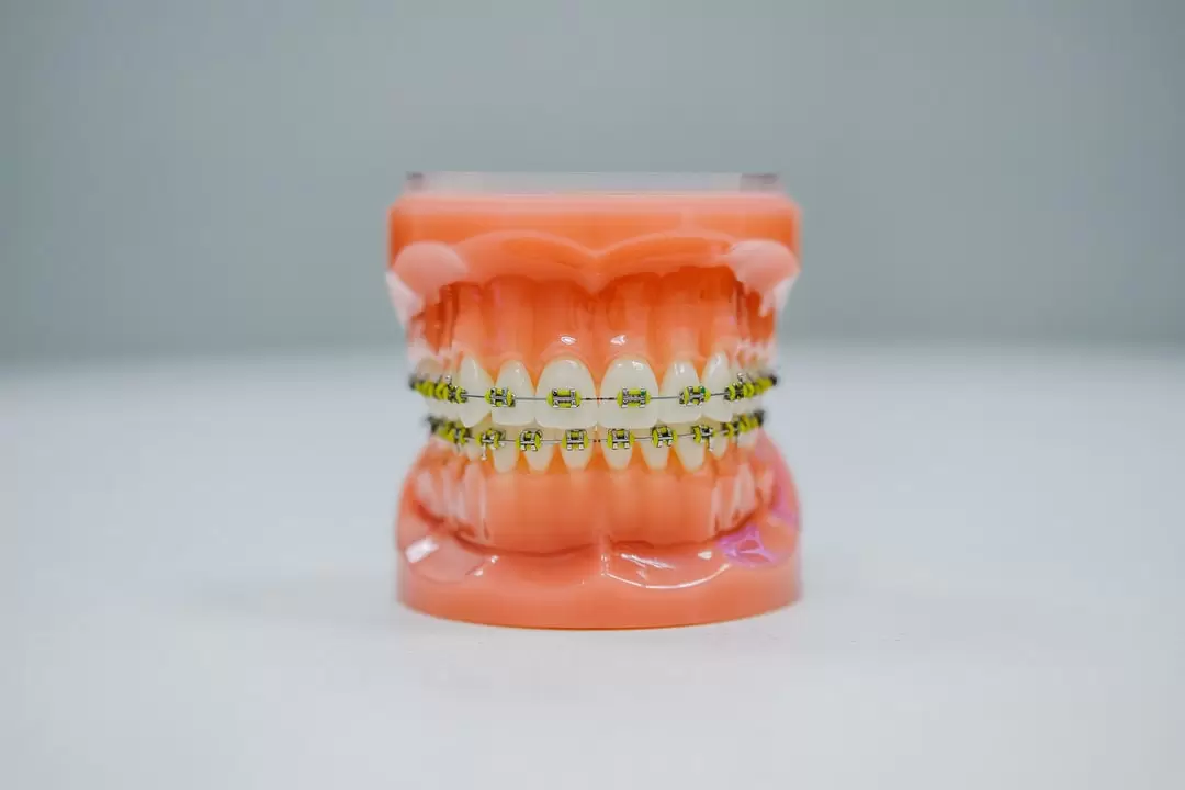 The Timeline of Getting Braces: From Consultation to Removal