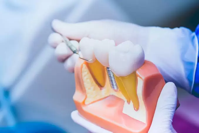 Cosmetic Dental Implants: Frequently Asked Questions