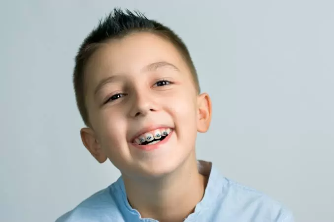 The Different Types of Dental Braces That Are Prescribed Today
