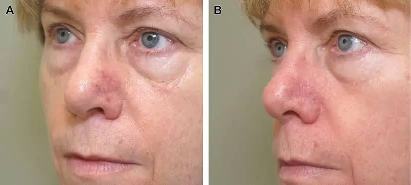 Microneedling vs Chemical Peel: Exploring the Differences