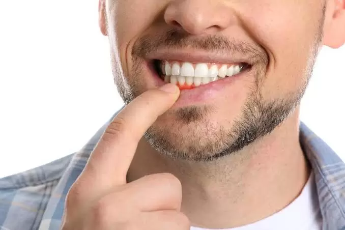 How to Prevent Gum Disease: A Quick Guide