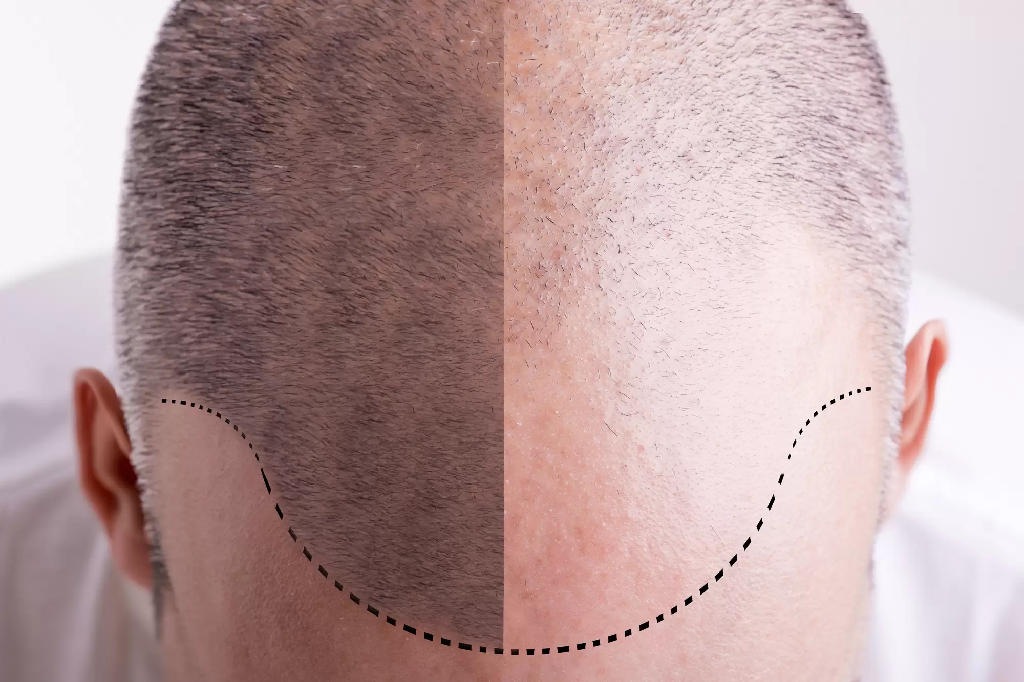 What Are the Benefits of Getting a Scalp Tattoo?