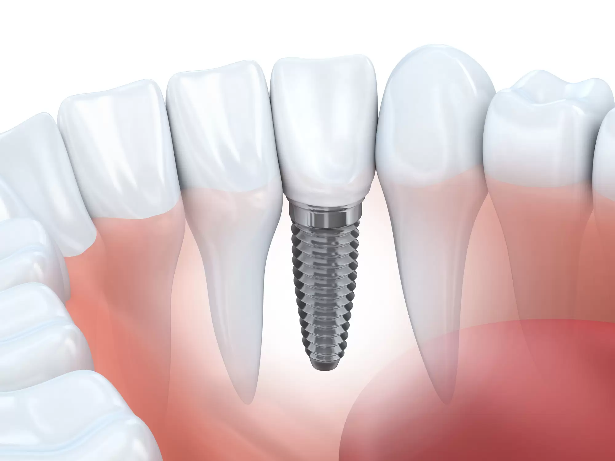Dental Implants vs Root Canal: What Are the Differences?
