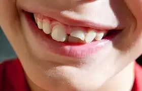 Cracked Teeth? What to Do if You Chip a Tooth