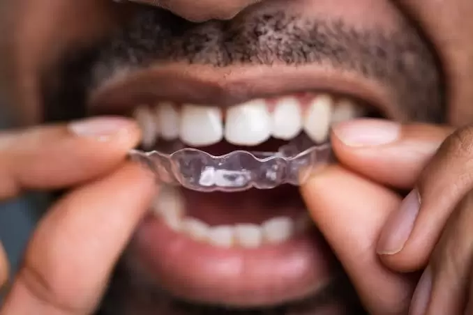 How to Select an Invisalign Dentist: Everything You Need to Know