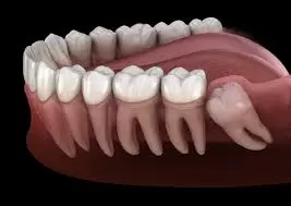 Impacted Wisdom Teeth vs Non Impacted: What Are the Differences?