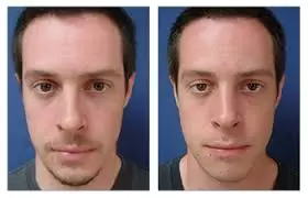 Closed vs Open Rhinoplasty: What’s the Difference?