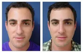 The Healing Stages of Rhinoplasty Surgery