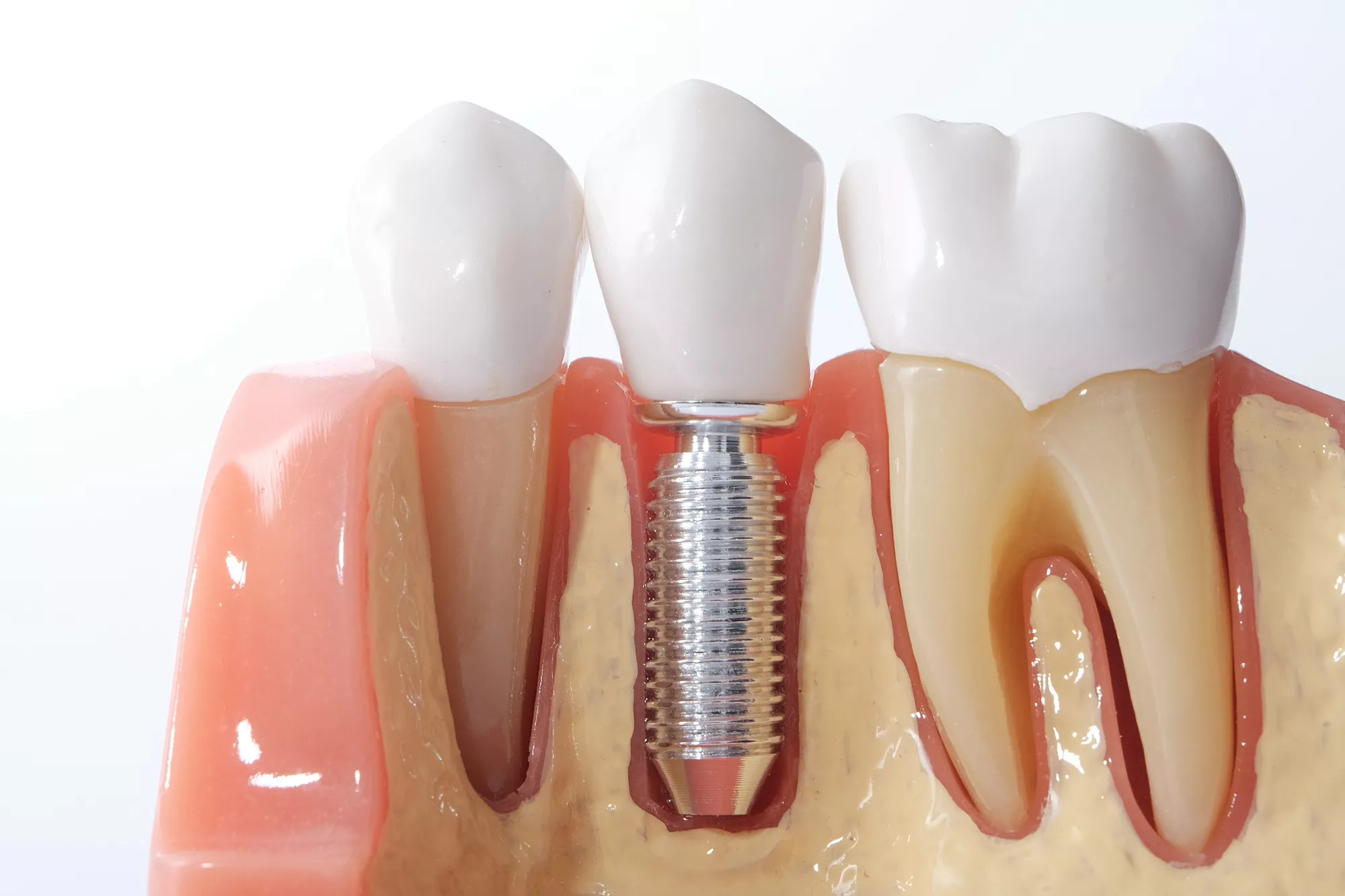 What Are the Different Types of Dental Implants That Exist Today?