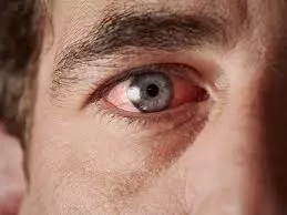 Why Are My Eyes So Dry?