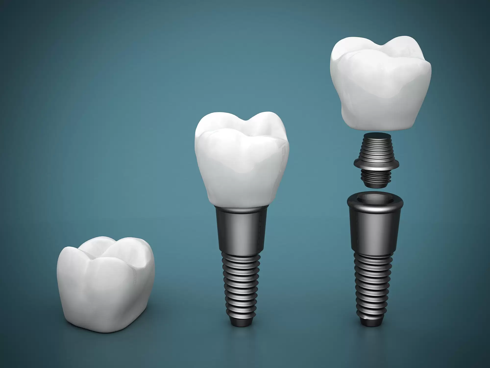 What Are the Different Types of Dental Implants That Are Prescribed?
