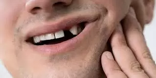 How to Replace Missing Teeth