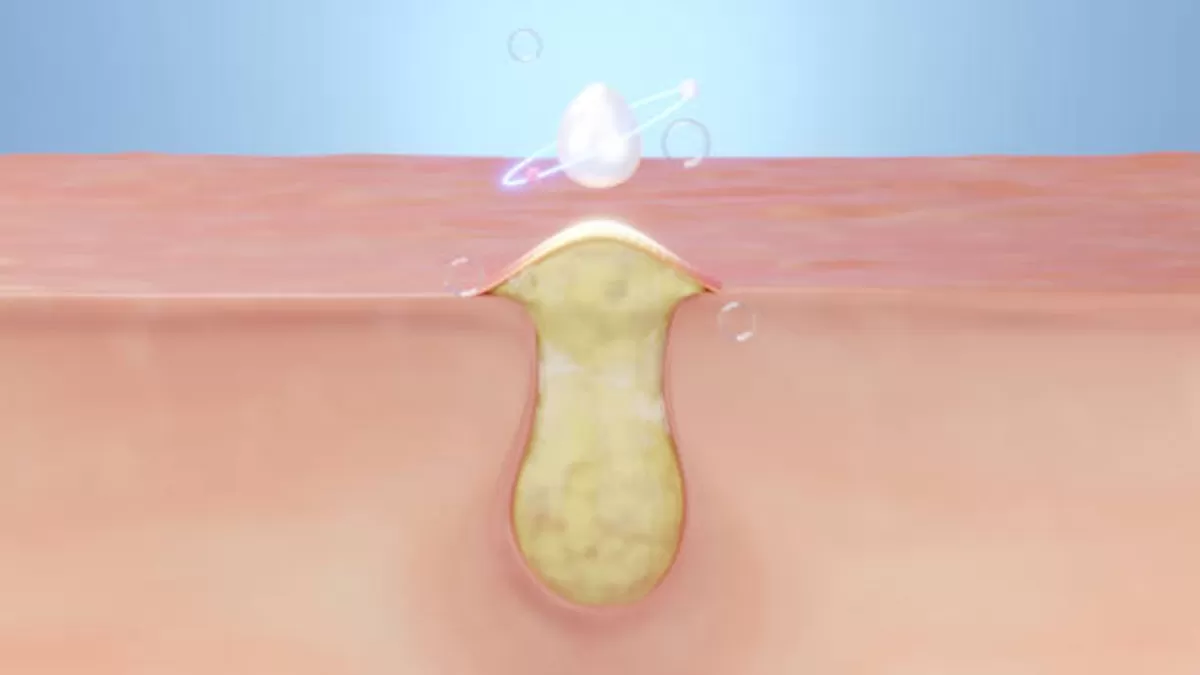 Follicle Rupture and Ovulation